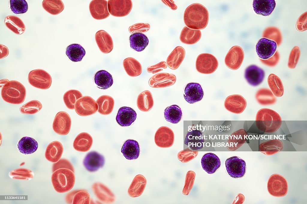 Acute lymphoblastic leukaemia, illustration