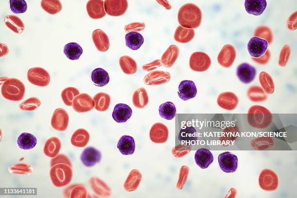 acute lymphoblastic leukaemia, illustration - histology 幅插畫檔、美工圖案、卡通及圖標