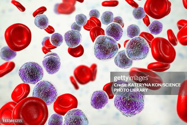 ilustrações, clipart, desenhos animados e ícones de acute lymphoblastic leukaemia smear, illustration - oncology