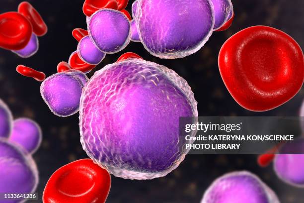 acute lymphoblastic leukaemia smear, illustration - bone marrow stock illustrations