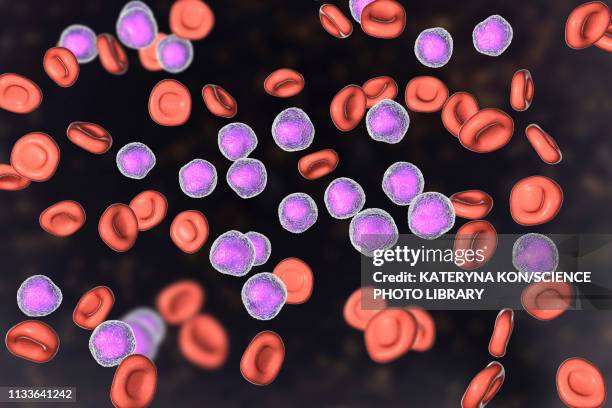 acute lymphoblastic leukaemia smear, illustration - bone marrow stock illustrations