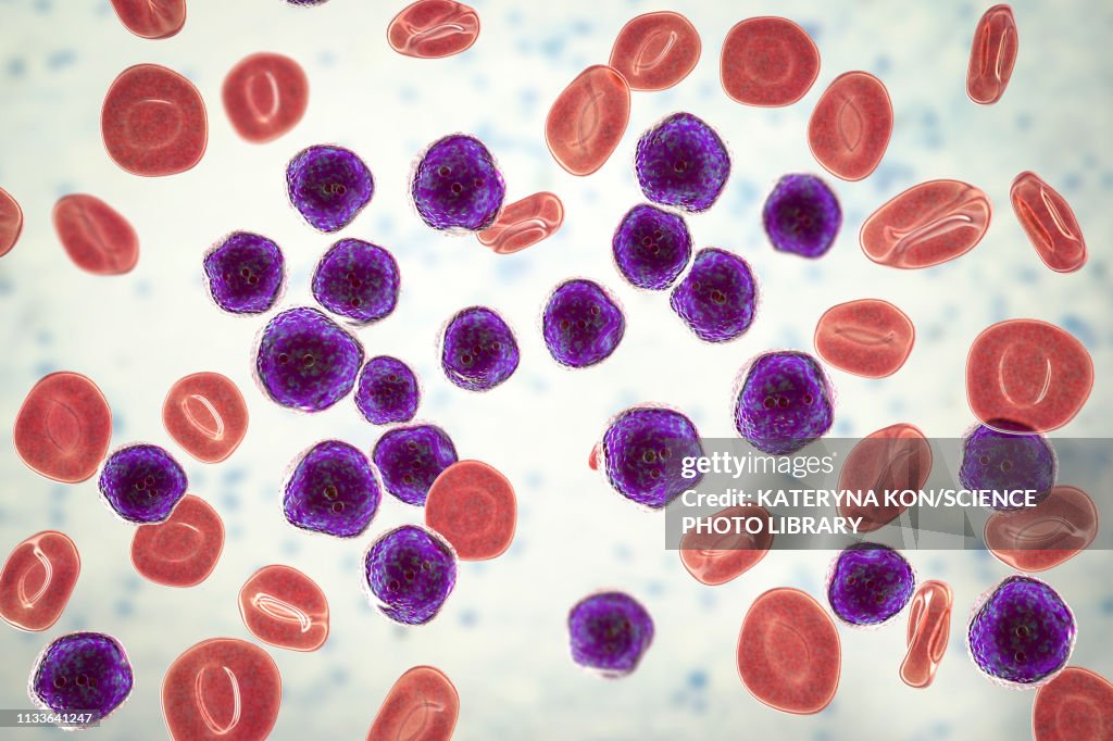 Acute lymphoblastic leukaemia smear, illustration