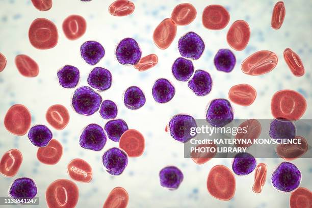 acute lymphoblastic leukaemia smear, illustration - histology stock illustrations