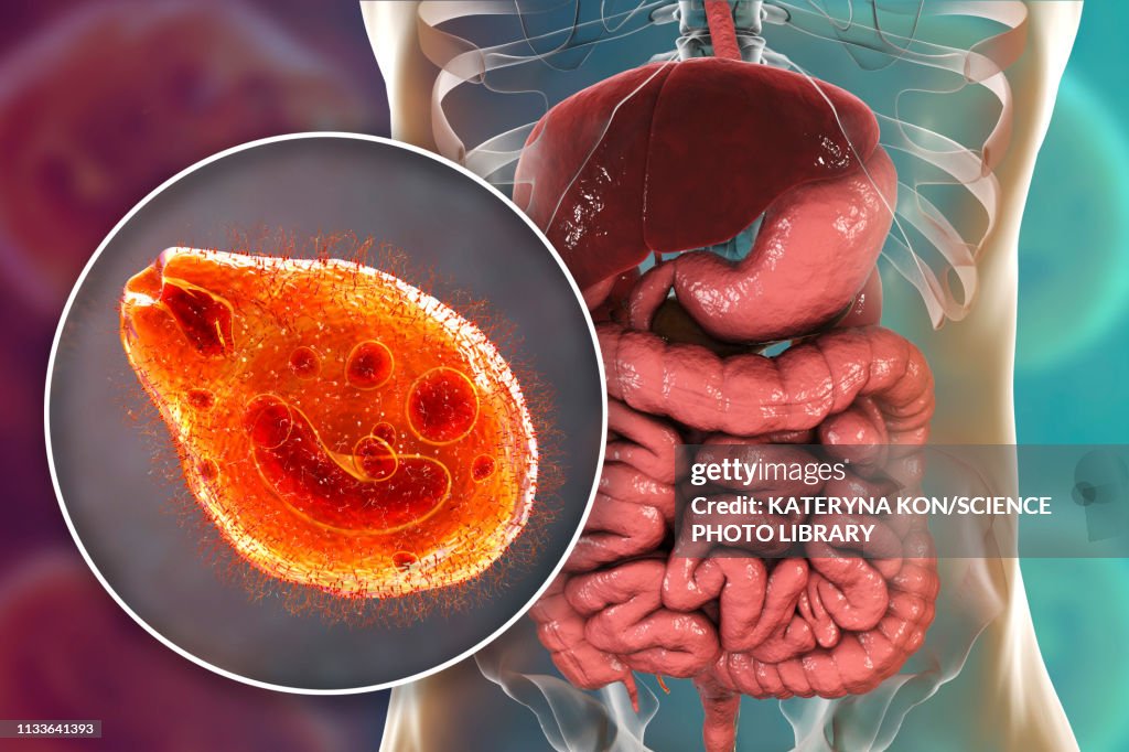 Balantidiasis, conceptual illustration