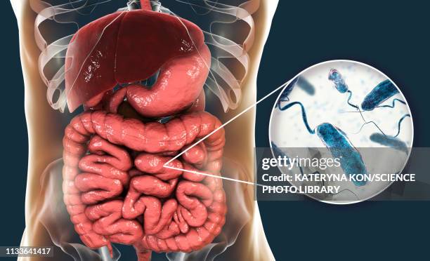 cholera infection, illustration - cholera stock illustrations