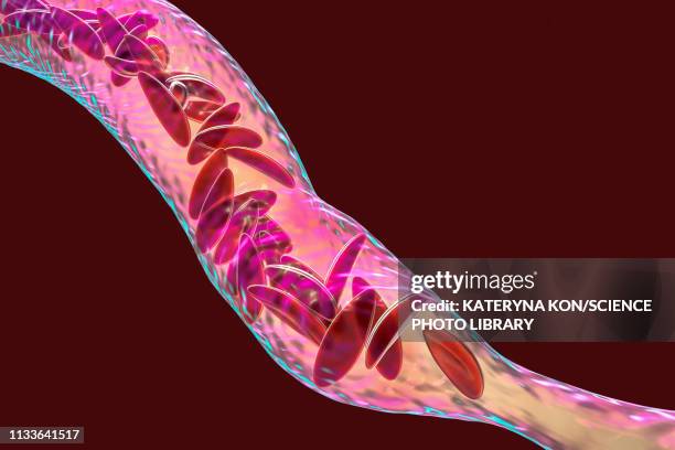 blood vessel blocked in sickle cell anaemia, illustration - sickle cell stock illustrations