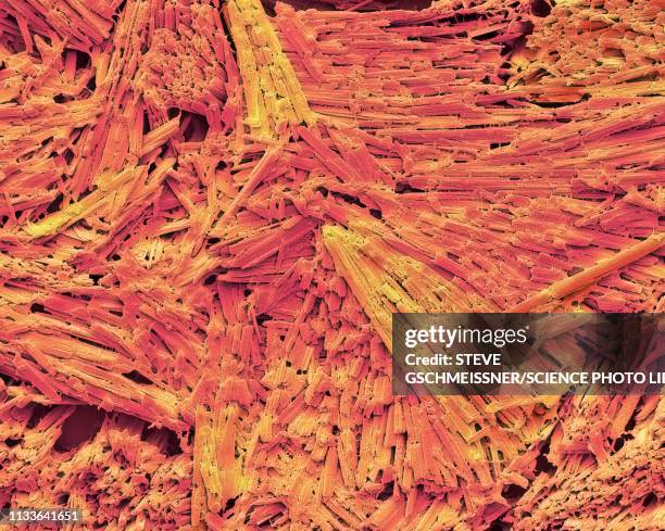 stockillustraties, clipart, cartoons en iconen met uric acid crystals in gout, sem - gout