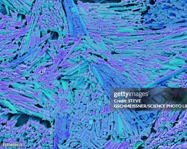 illustrations, cliparts, dessins animés et icônes de uric acid crystals in gout, sem - arthrite