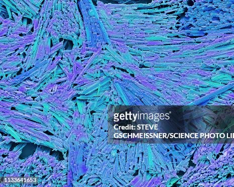 Uric Acid Crystals In Gout Sem High-Res Vector Graphic - Getty Images