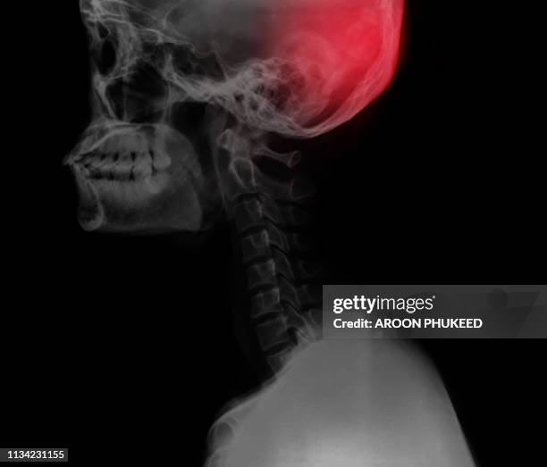 brain pain x ray with red area - human anatomy organs back view fotografías e imágenes de stock