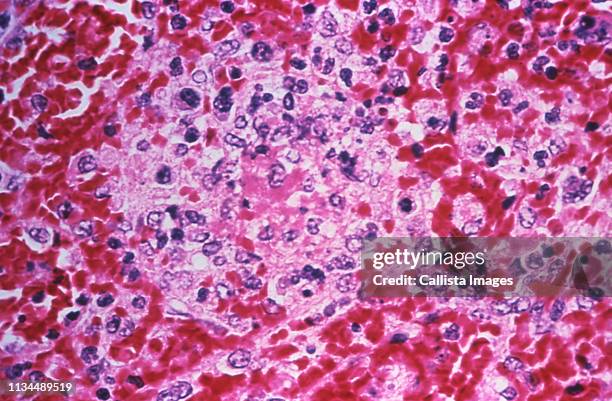 splenic tissue in a case of fatal human plague - petechiae stockfoto's en -beelden