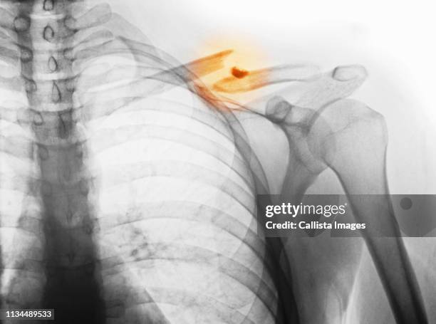 x-ray showing fractured clavicle - clavícula fotografías e imágenes de stock