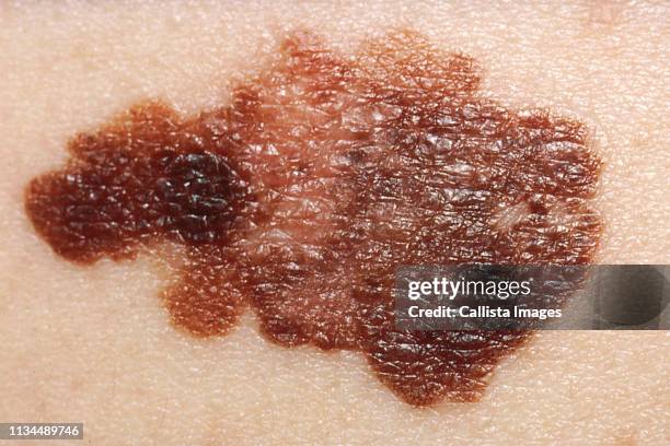 melanoma, skin cancer - mole stockfoto's en -beelden