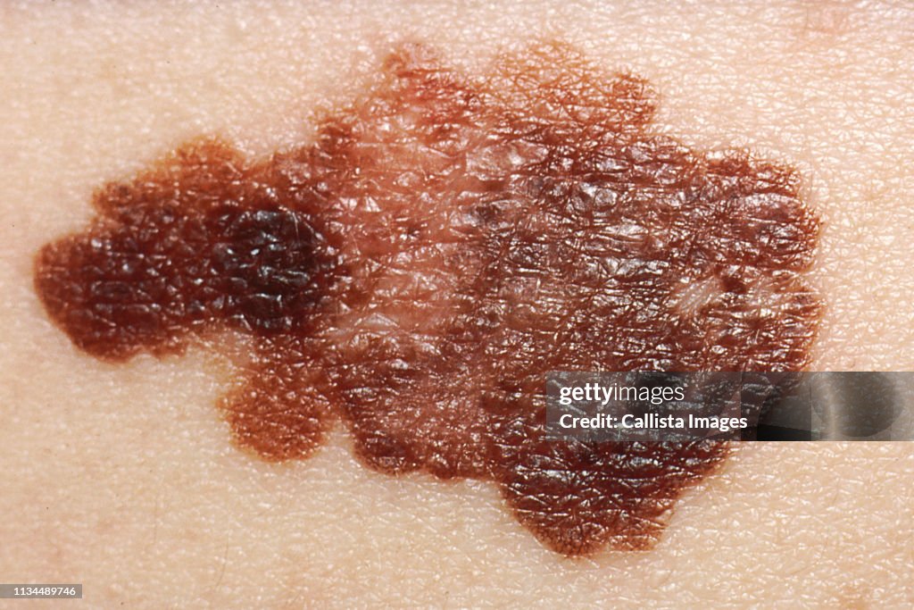 Melanoma, Skin Cancer