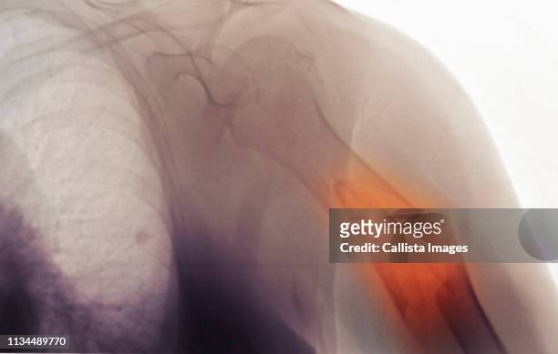x-ray showing a comminuted fracture of the humerus - comminuted fracture stock pictures, royalty-free photos & images