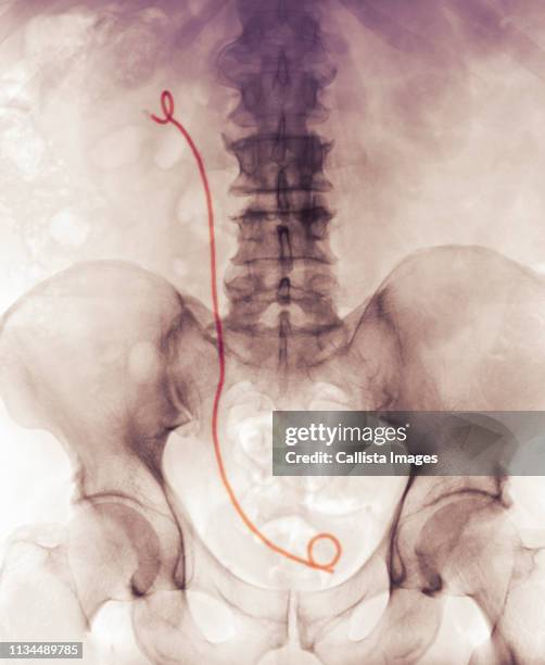 x-ray showing a ureteral stent - stent stockfoto's en -beelden