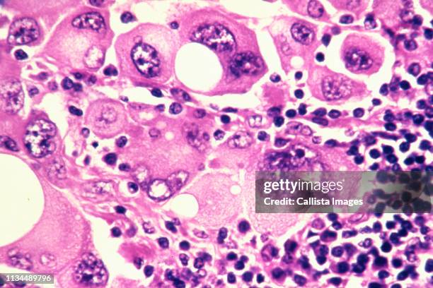 human metastatic melanoma cells - melanoma stock pictures, royalty-free photos & images