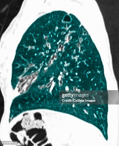 ct scan of chest showing cystic fibrosis - cystic fibrosis 個照片及圖片檔