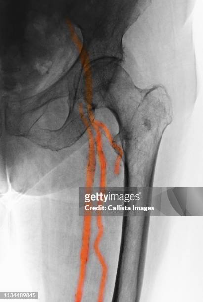 x-ray of artery calcifications - calcification stock pictures, royalty-free photos & images