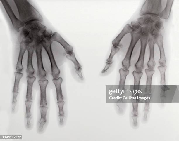 x-ray of two hands showing rheumatoid arthritis - artritis-reumatoide fotografías e imágenes de stock