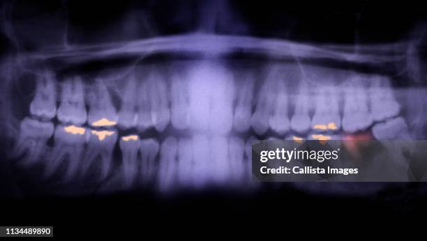 panorex of teeth showing cavities - rotten teeth from not brushing 個照片及圖片檔