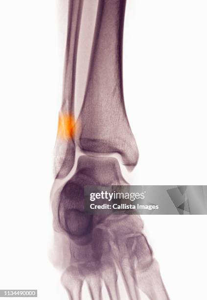 ankle x-ray showing fractured distal fibula - ankle anatomy stock pictures, royalty-free photos & images