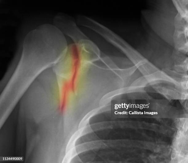 x-ray showing fracture of scapula - escapula fotografías e imágenes de stock