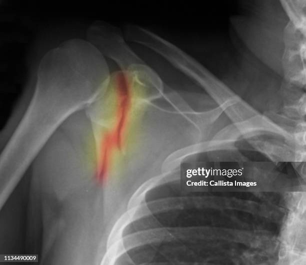 x-ray showing fracture of scapula - scapula stock pictures, royalty-free photos & images