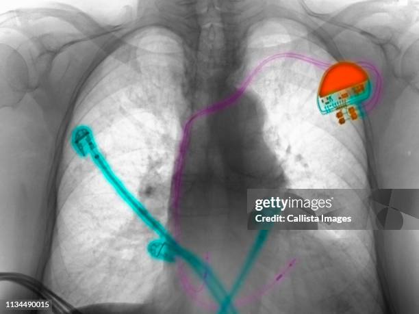 Foto Pacemaker 56 Pacemaker Monitor Stock Photos, High-Res Pictures, and Images ...