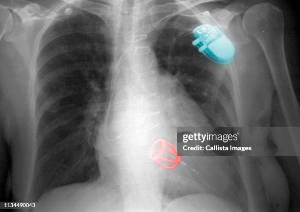 Gi Pacemaker 270 Pacemaker Surgery Stock Photos, High-Res Pictures, and Images ...