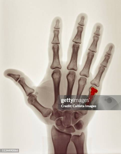 52 Boxer Fracture Stock Photos, High-Res Pictures, and Images - Getty ...