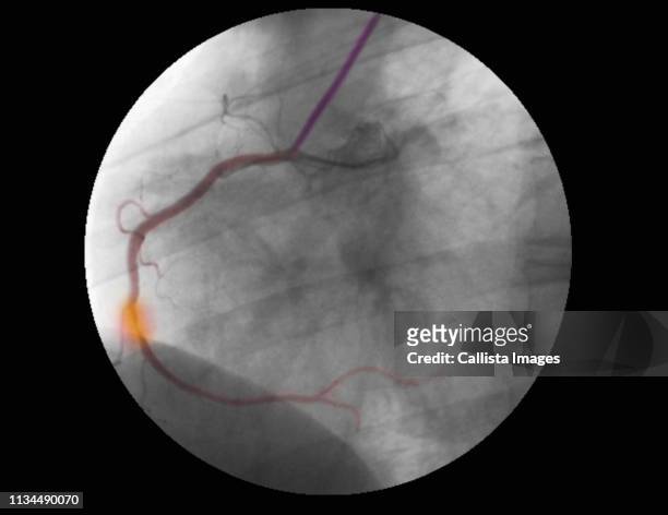 angiogram of rca showing stenosis and repair - artériosclérose photos et images de collection