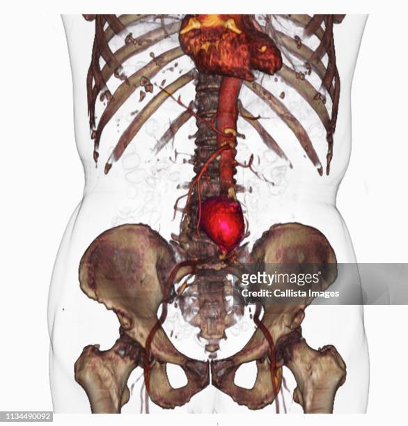ct scan image showing an abdominal aortic aneurysm - aortic aneurysm stock pictures, royalty-free photos & images