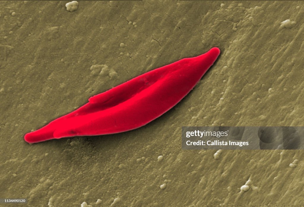 SEM of a sickle cell red blood cell