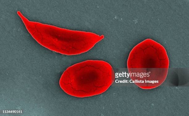 sem of sickle cell and normal red blood cells - eisenmangel stock-fotos und bilder
