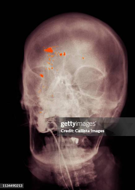 colorized x-ray of skull showing gunshot wound - head wound stock pictures, royalty-free photos & images