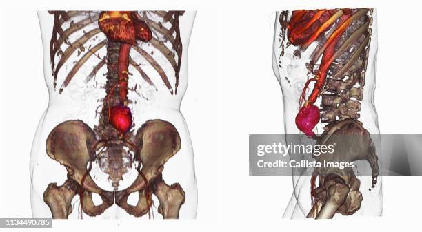 two ct scan images of an abdominal aortic aneurysm - aorta imagens e fotografias de stock