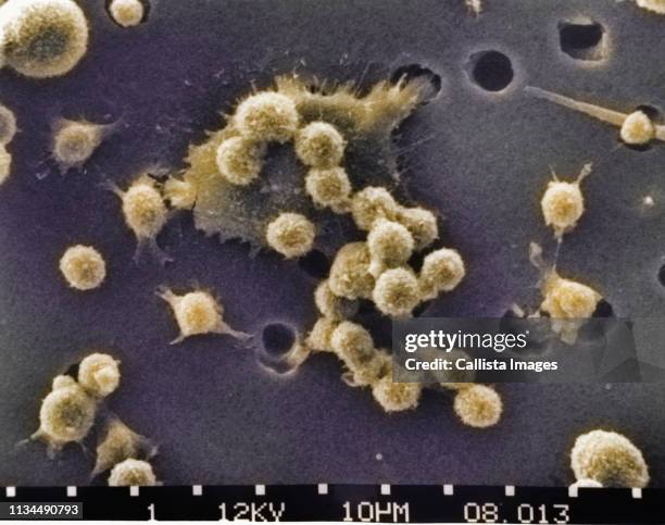 sem of death of a cancer cell (6 step sequence) - electron microscope micrographs stock pictures, royalty-free photos & images