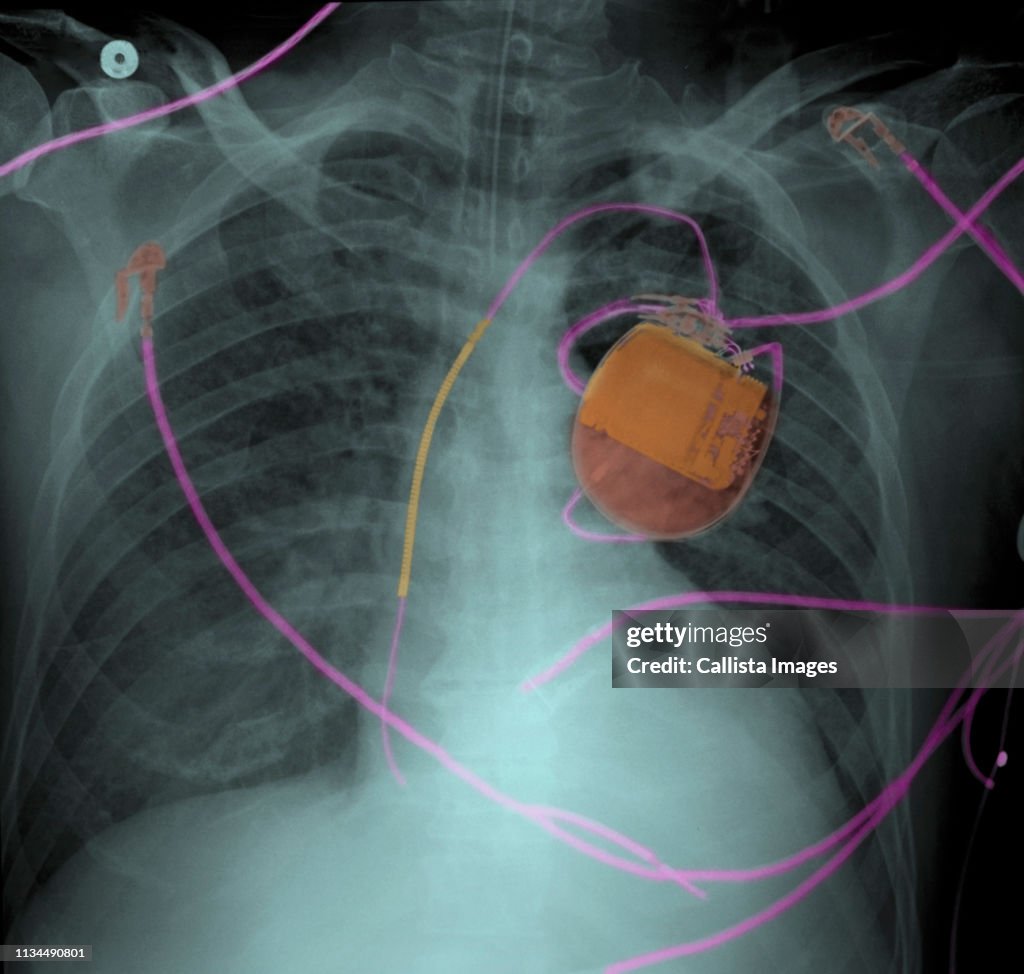 Chest x-ray of pacemaker and pulmonary edema