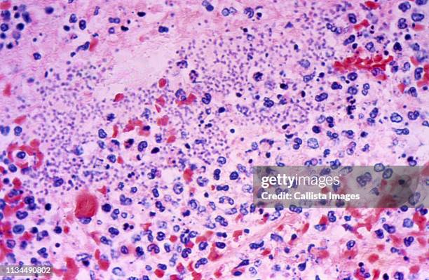 splenic tissue in a case of fatal human plague - histology stock-fotos und bilder