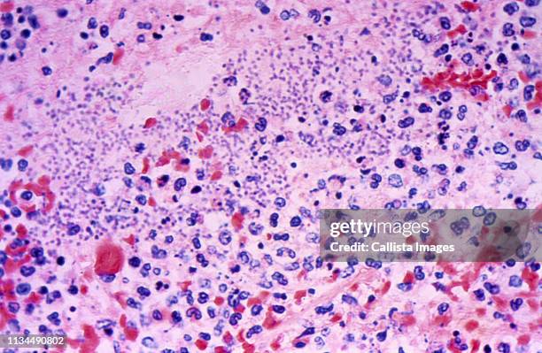 splenic tissue in a case of fatal human plague - histologia - fotografias e filmes do acervo