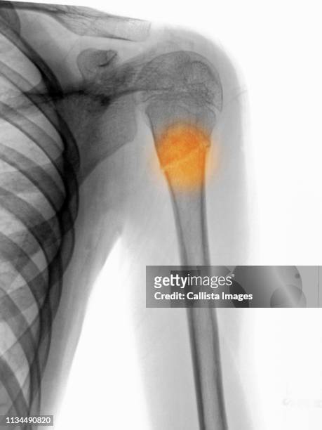 x-ray showing a proximal humerus fracture - humerus stock pictures, royalty-free photos & images