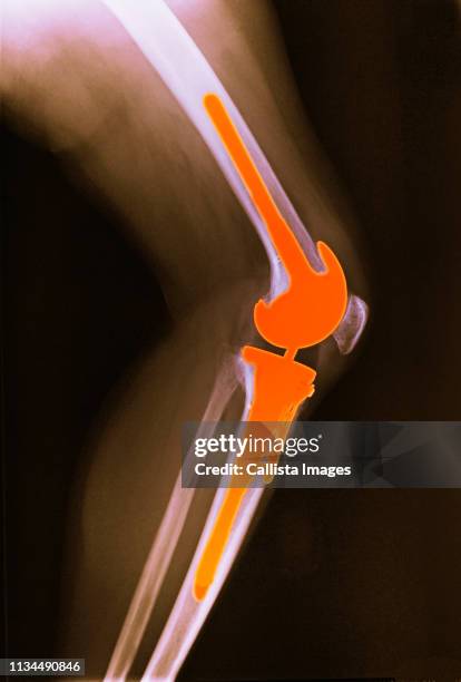 x-ray of leg with total knee replacement - knee replacement surgery stock pictures, royalty-free photos & images