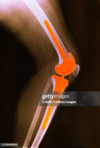 x-ray of leg with total knee replacement - knee replacement surgery - fotografias e filmes do acervo