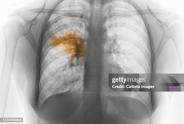 x-ray of chest showing pneumonia - neumonía fotografías e imágenes de stock