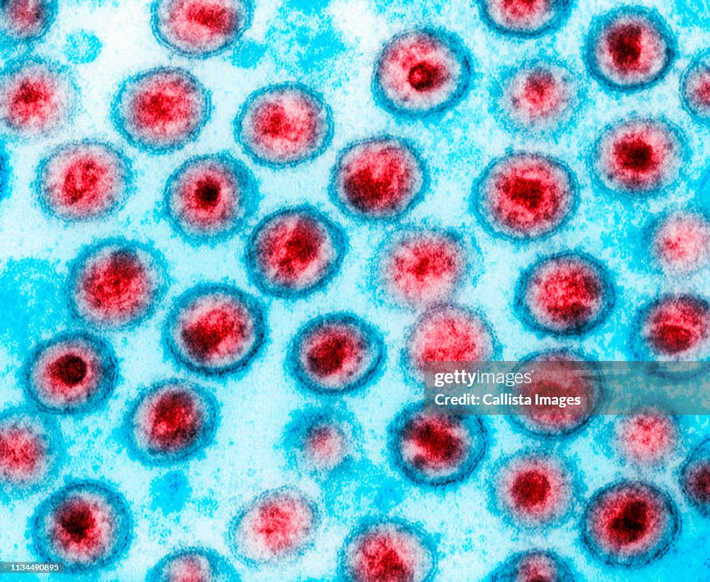 Transmission electron micrograph of AIDS, HIV-1