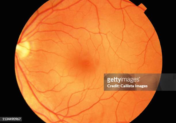 fundus photograph showing a normal retina - retina stock pictures, royalty-free photos & images