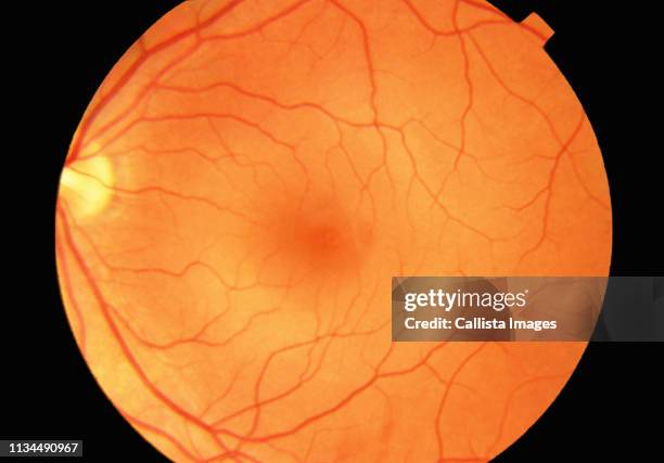 fundus photograph showing a normal retina - fundo gástrico imagens e fotografias de stock