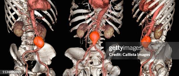 ct scan images of an abdominal aortic aneurysm - aortas stock pictures, royalty-free photos & images