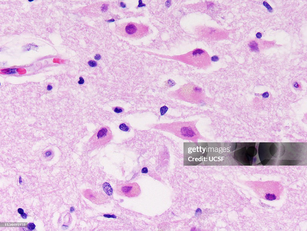 Brain hypoxia, hippocampus, neurons